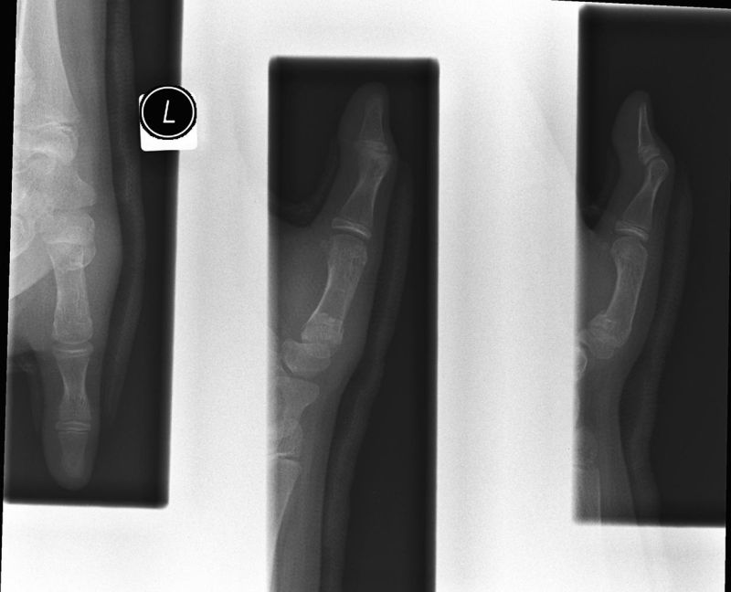 finger radiography