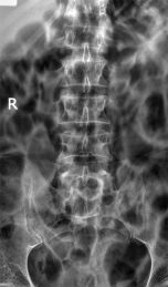 AP lumbar spine radiography