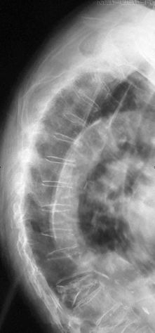Lateral Thoracic Spine Digital Double-Dipping - wikiRadiography