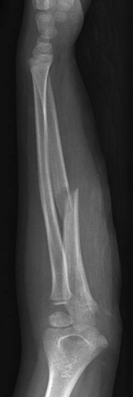 Monteggia and Galeazzi Fracture-dislocations of the Forearm - wikiRadiography