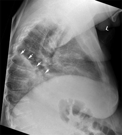 left lower lobe collapse, cons,effusion