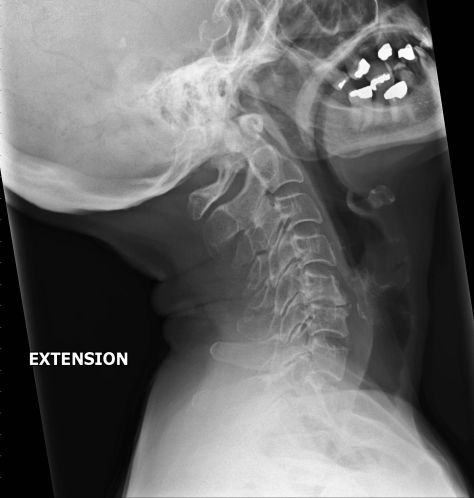 Flexion and extension C spine