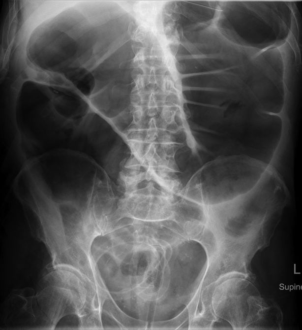 large bowel obstruction