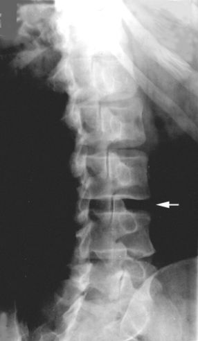 oblique lumbar spine