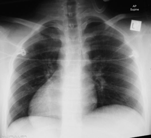 Dextracardia in the Resus Room - wikiRadiography