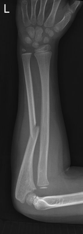Monteggia and Galeazzi Fracture-dislocations of the Forearm - wikiRadiography