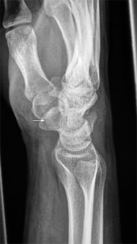 pisiform fractures