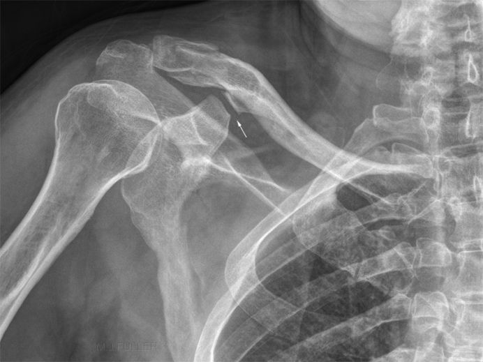 coracoclavicular joint