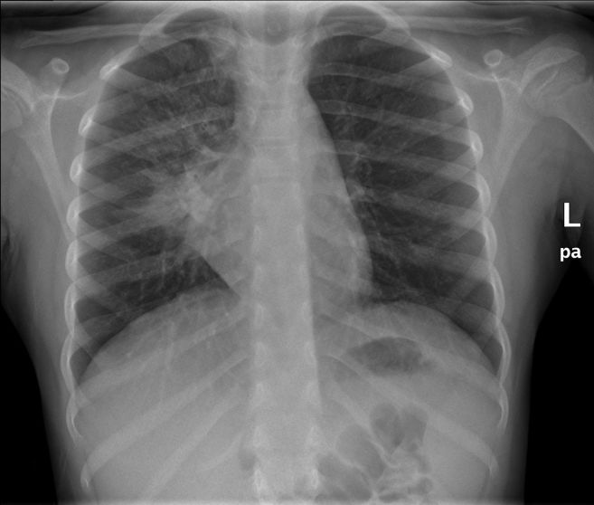 Notes on Paediatric Chest Radiography - wikiRadiography