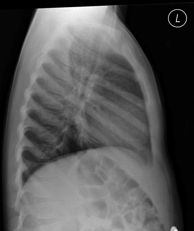 Notes on Paediatric Chest Radiography - wikiRadiography