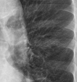 LINEAR LUNG PATTERN