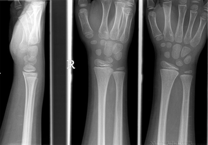 Paediatric Wrist Trauma - wikiRadiography