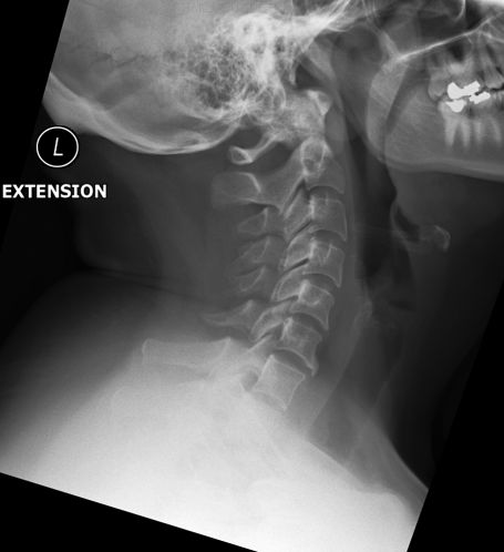 Flexion and extension C spine