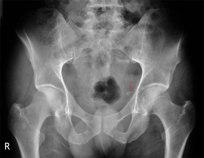Pelvis Artifacts, variants and calcifications - wikiRadiography