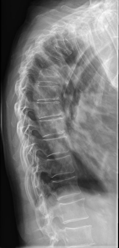 lateral thoracic spine