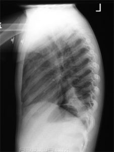 lateral chest X-ray