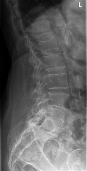 Lateral Lumbar Spine