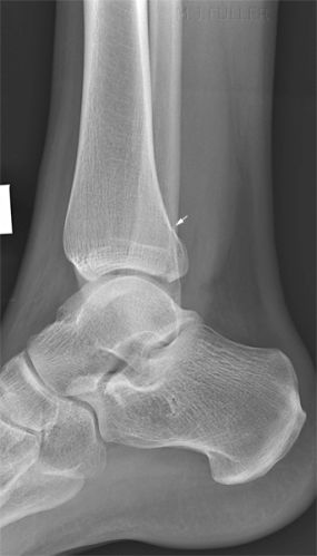 lateral ankle