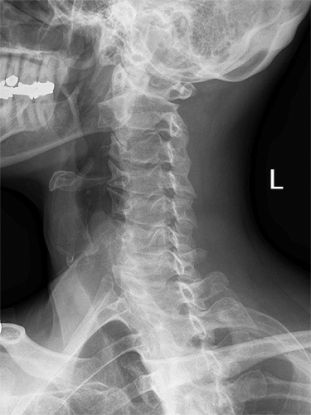 cervical spine oblique positioning error