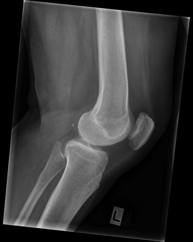 LATERAL KNEE