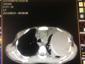 bronchogenic cyst by Dr.Moslehi