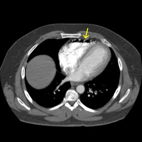 CT Case 1 - Iatrogenic Venous Air Embolism - wikiRadiography