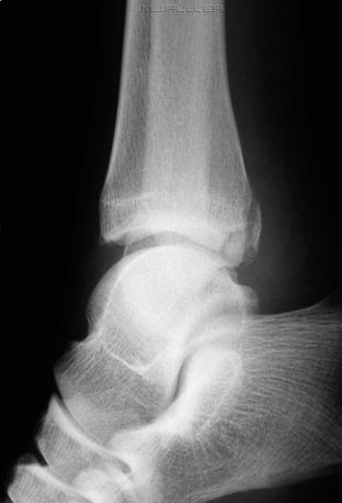 The Lateral Ankle Trap - wikiRadiography