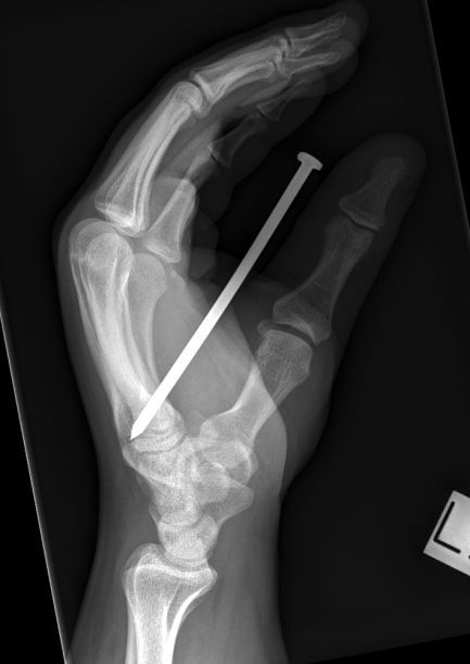 nail gun injury