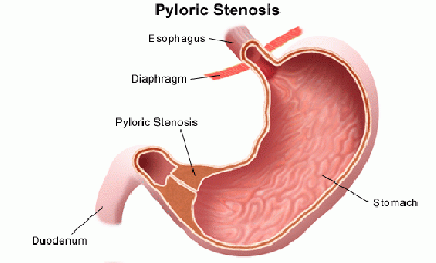 Pyloric Stenosis