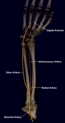 CT Case 2 - Hypoplastic Radial Artery - wikiRadiography